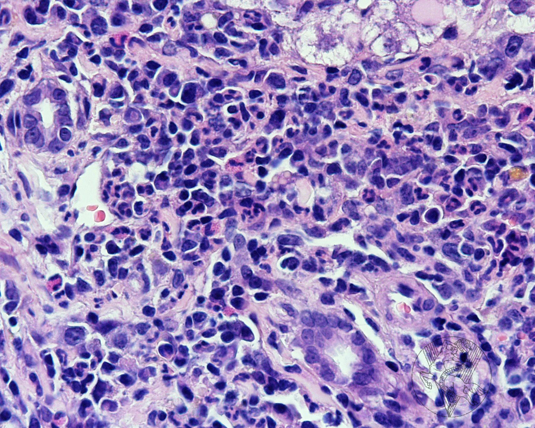 Pericholangitis in hypereosinophilic syndrome - cat